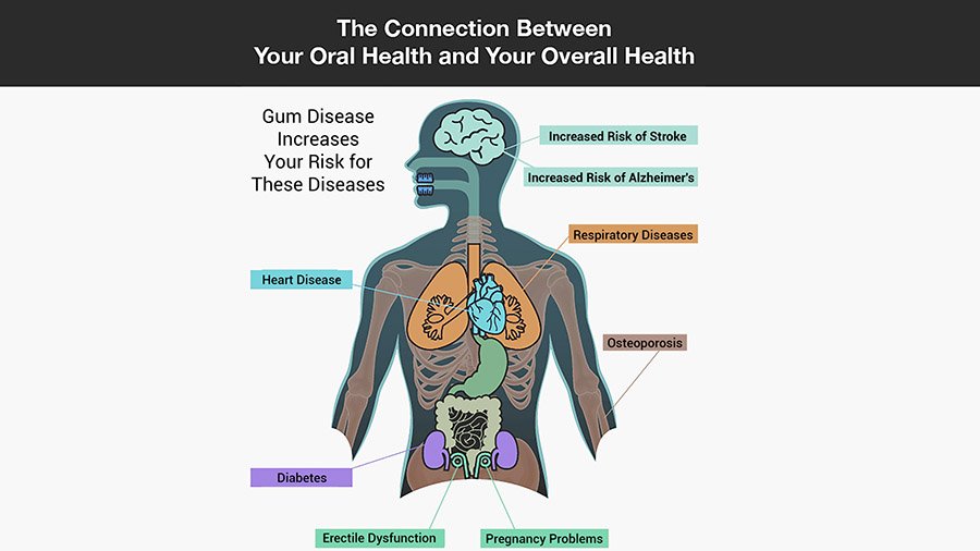 The connection between gum disease and other diseases (e.g. stroke, heart disease) shown in a graph.