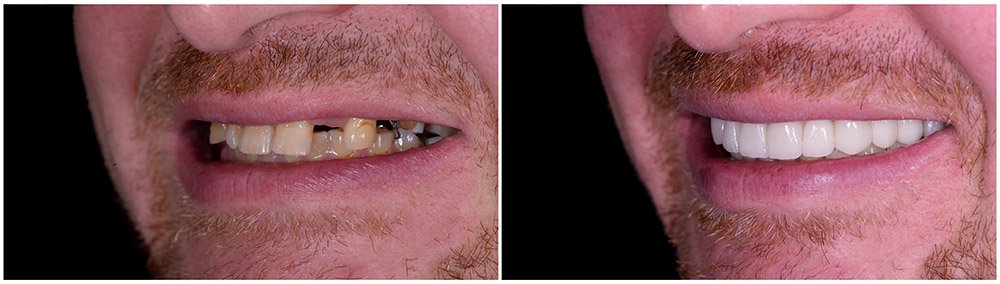 Before and after images of a smile transformation using all-on-four dental implants. This implant procedure includes placing four implants in the jawbone to support a full set of porcelain teeth.